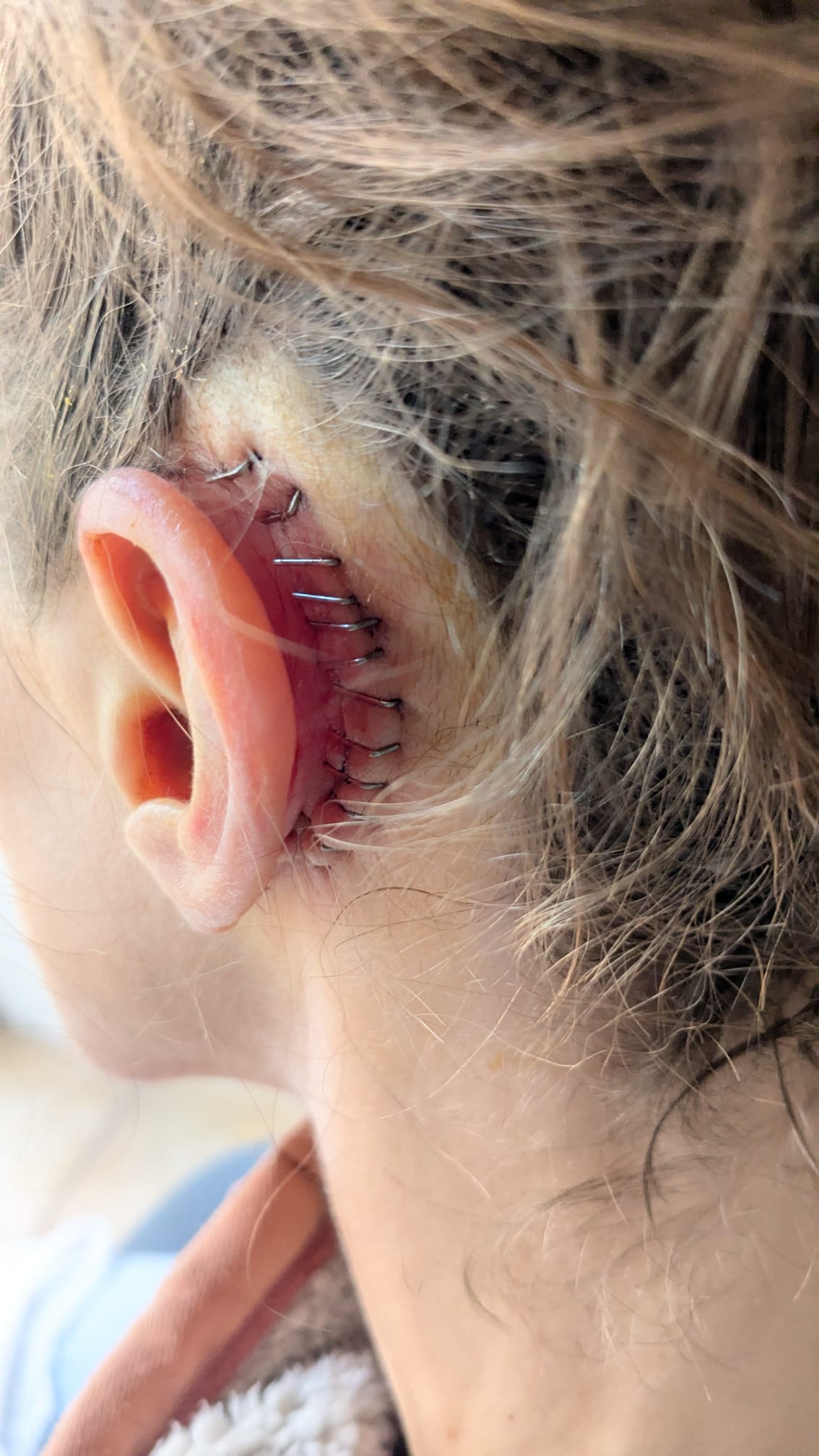 Close up of the back of Carly's ear, showing an incision site with 12 staples.