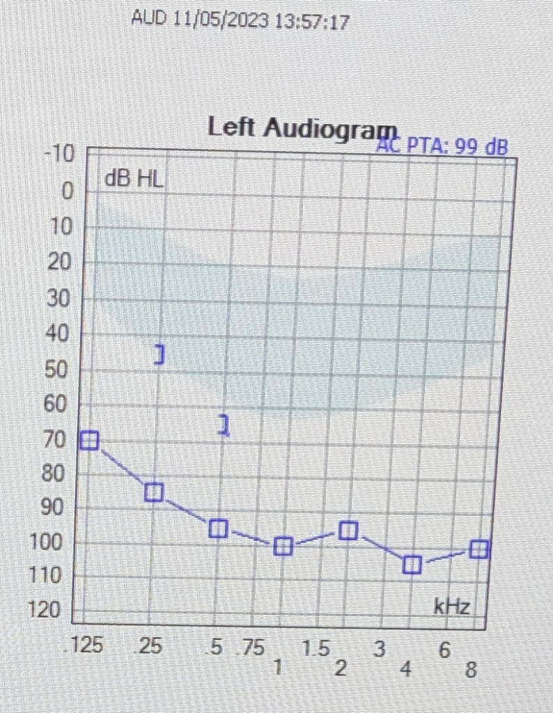My audiogram before getting a CI, showing a severe-to-profound hearing loss. 