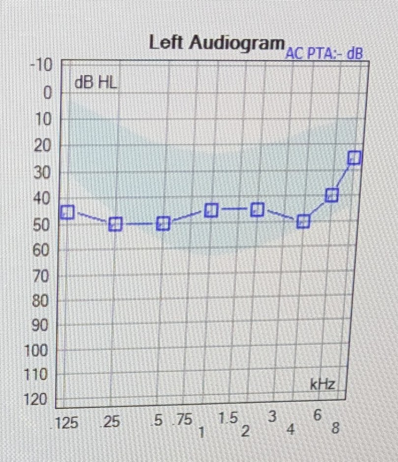 Audiogram showing a mild-moderate hearing loss